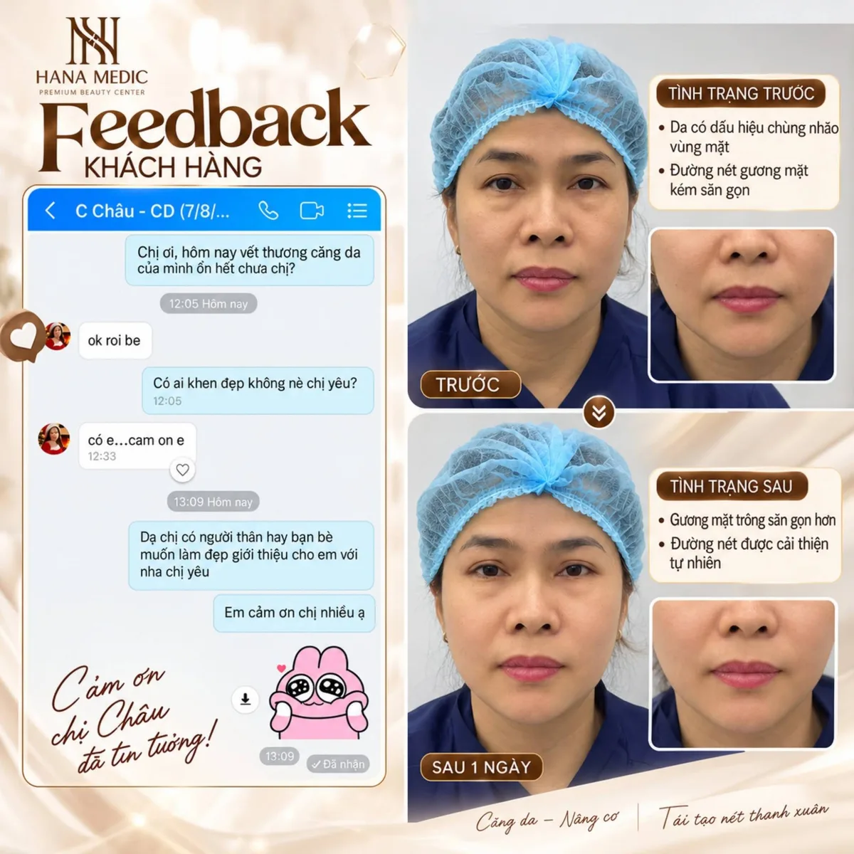 Trước và sau 1 ngày căng da mặt nâng cơ của chị Châu